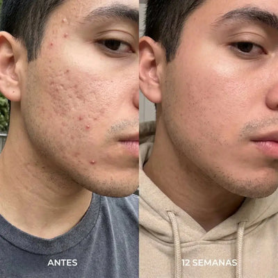 Nuva Stick: Reparador de Cicatrices